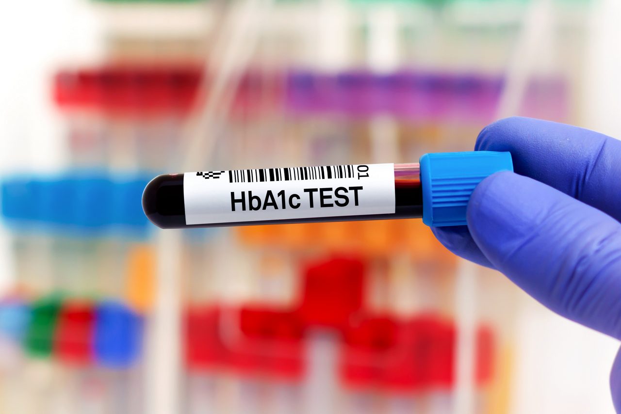 doctor holding Blood tube for HbA1c analysis and identification of diabetic patient. Blood sample for study of HbA1c or Hemoglobin A1c for detection of diabetes