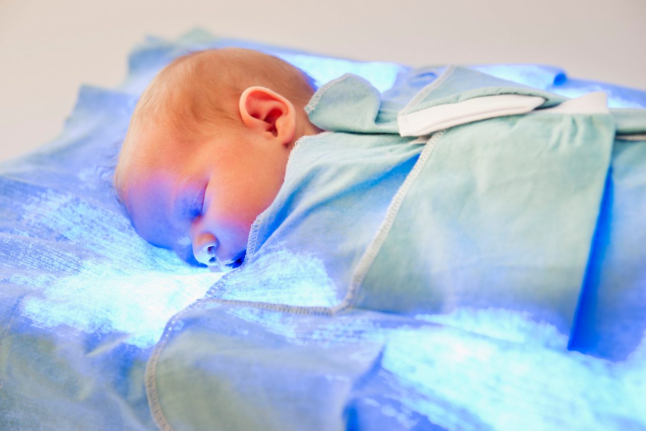 Stockphoto of a newborn girl undergoing phototherapy treatment for hyperbilirubinemia,  a very common newborn condition.