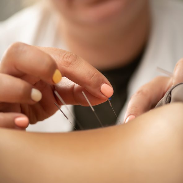 Close up of a client receiving acupuncture.