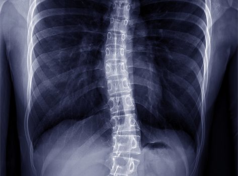 Spinal x-ray
