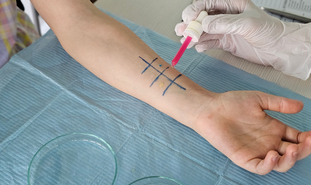 A person receiving an allergy test