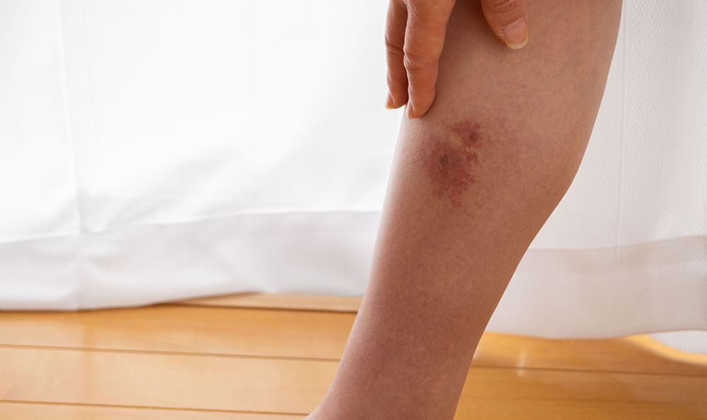 Person with an infection on their leg.
