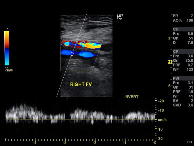 A Doppler ultrasound image is a noninvasive test that can be used to estimate the blood flow through your blood vessels by bouncing high-frequency sound waves (ultrasound) off circulating red blood cells.