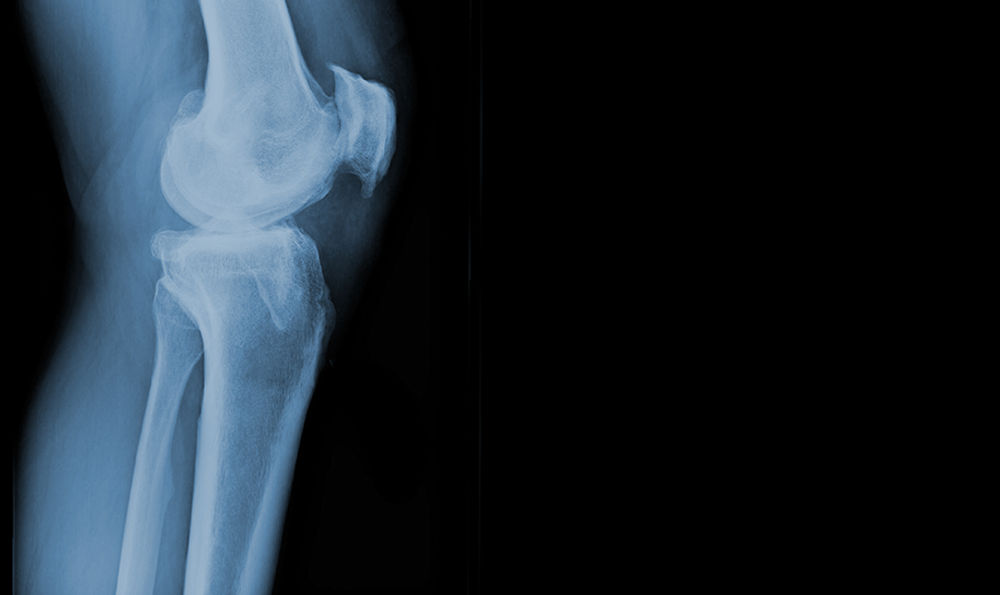 X-ray of a bone.