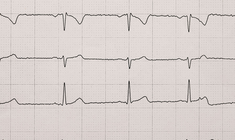 An image of a cardiac stress test result.