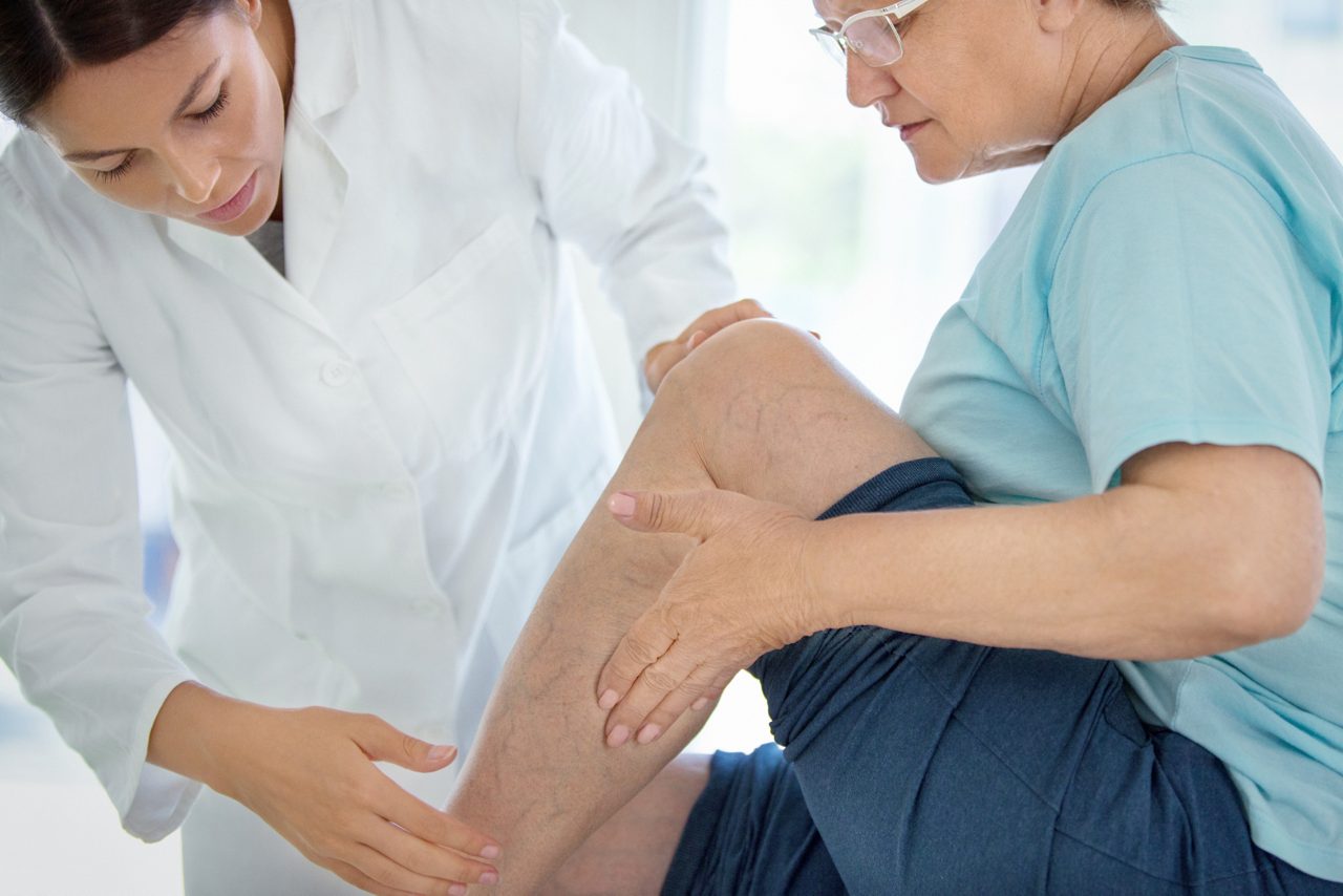 Closeup side view of  female doctor massaging legs and calves of a senior female patient with visible varicose veins.